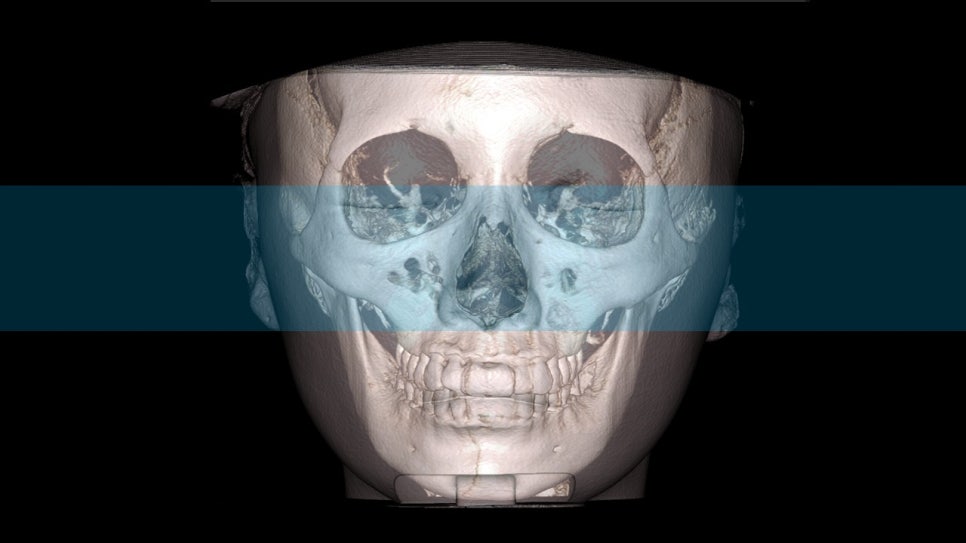 How Is Face Shape Determined? Factors That Determine Face Shape and Facial Contouring Surgery image 11