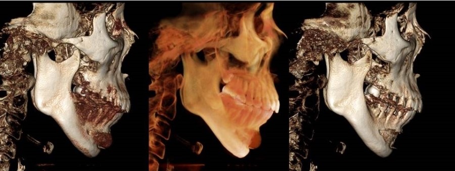 Various Methods of Chin Surgery for Correcting a Recessed Chin and Their Pros and Cons image 5