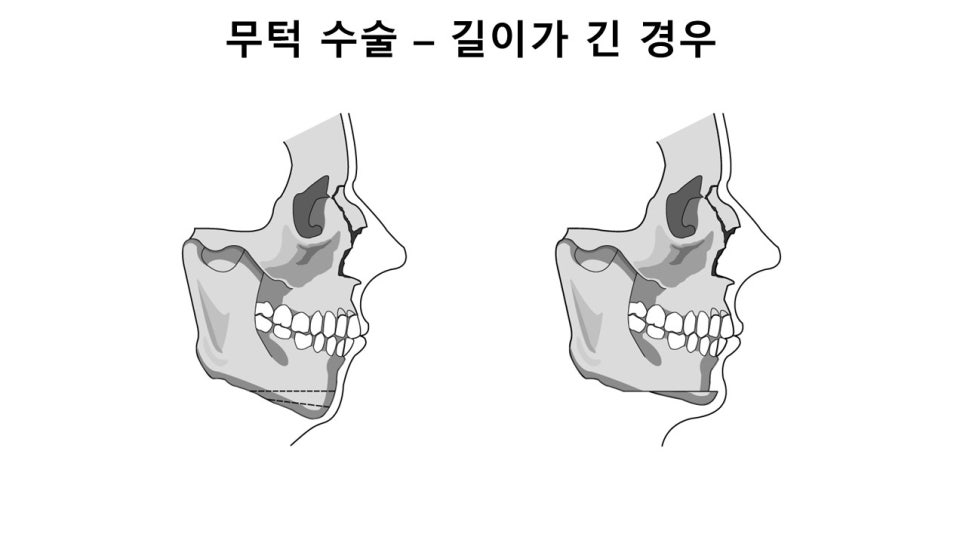 입체적인 옆라인의 완성, 무턱과 이중턱을 동시에 해결하는 방법 관련 이미지 22