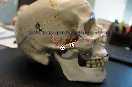 광대뼈 수술방법에 따른 문제점들.. 관련 이미지 2