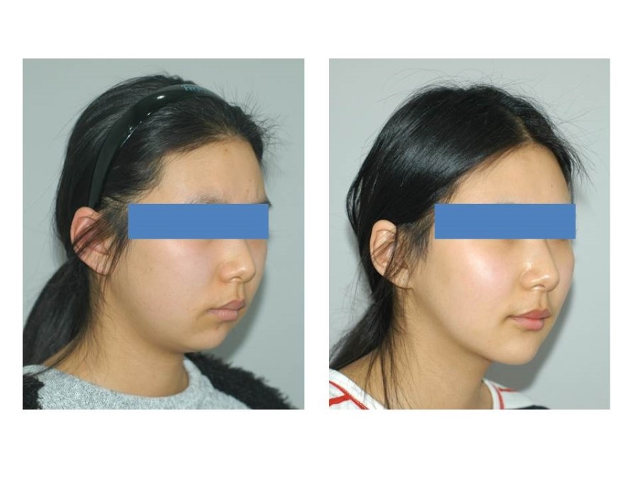 Deep Buccal Fat Removal, Double Chin Liposuction, and Progress After Genioplasty image 3