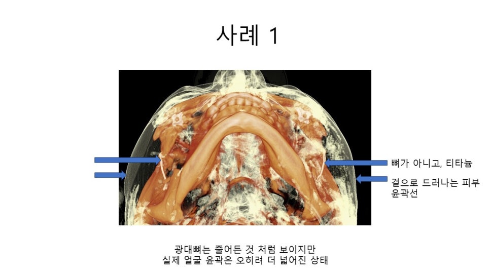 A Zygomatic Surgery Outcome That Makes Anger Surge image 7