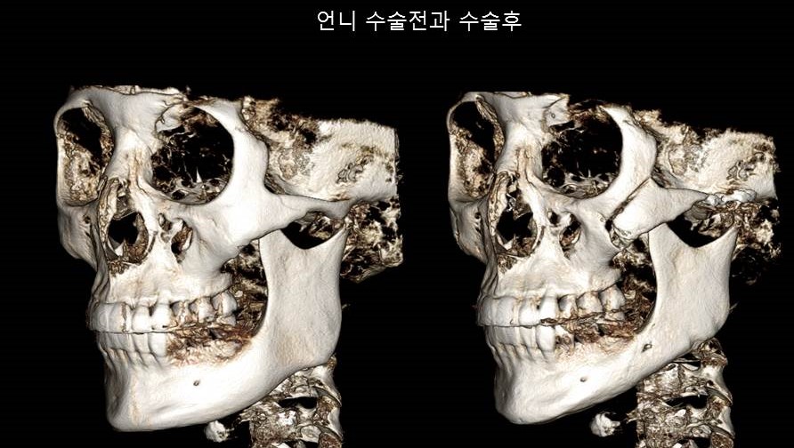 Understanding Square Jaw Surgery - Comparison of Postoperative Results Between Biological Sisters Who Underwent Surgery Using Different Methods image 4