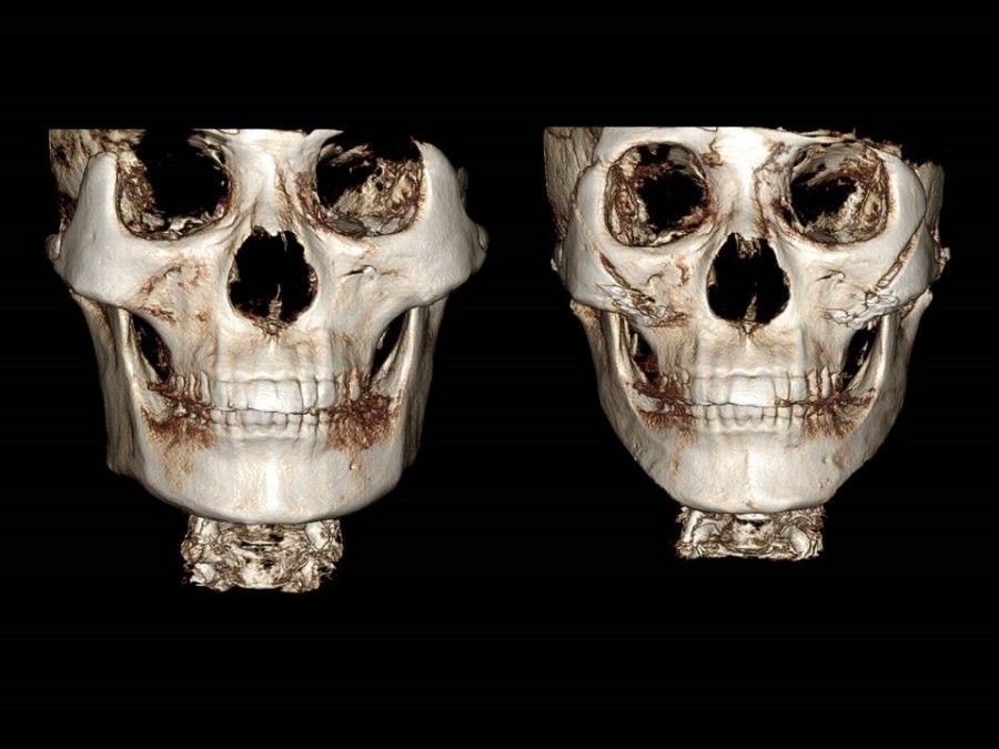 Zygoma Reduction Surgery Through Complete Osteotomy of the Body and Arch image 1