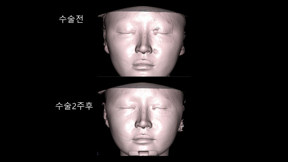 안면윤곽수술후 모습이 바뀌어 보이려면 얼마나 기다려야 할까? "윤곽수술과 술후 다운타임및 술후 관리방법" 관련 이미지 36