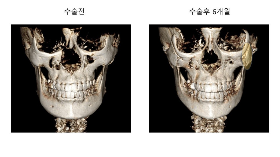 안면윤곽 수술전과 후의 증례 고찰 관련 이미지 2