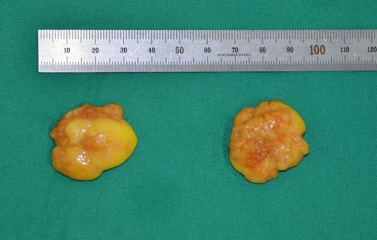 The Actual Appearance of Buccal Fat image 1