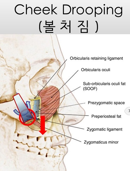 광대뼈축소성형술 - 볼처짐의 원인에 관한 이해 관련 이미지 5