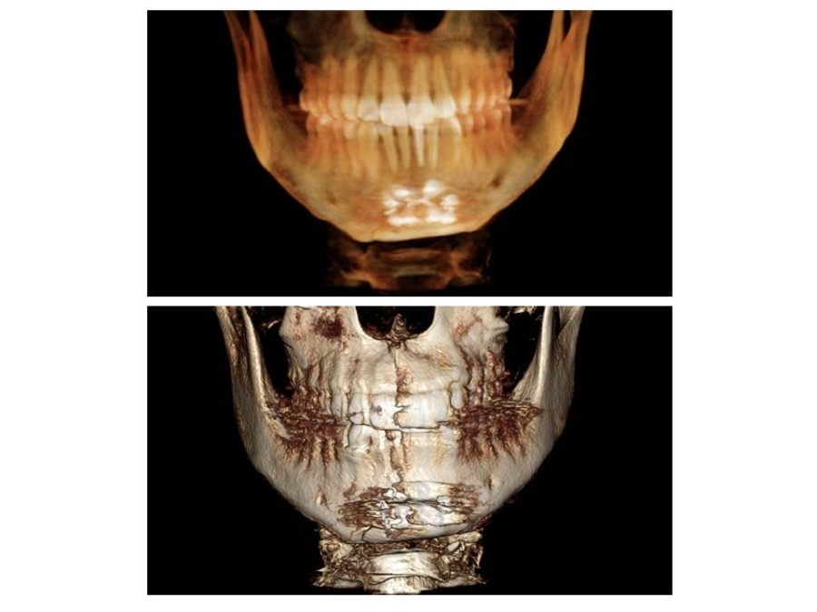 V-Line Square Jaw Surgery - The Appropriate Surgical Method According to the Shape of the Chin image 10