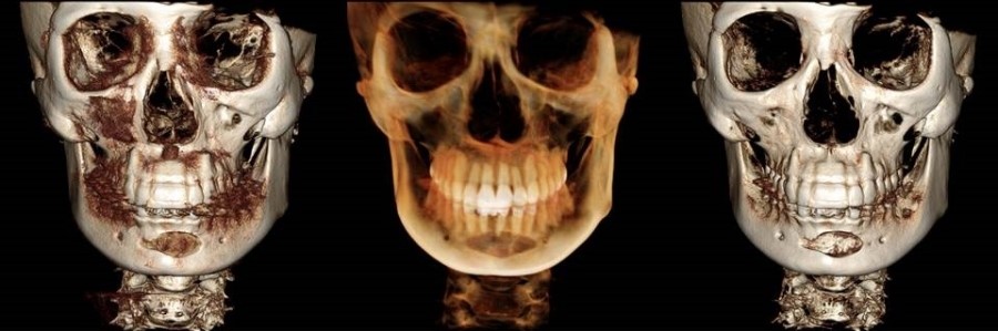 Various Methods of Chin Surgery for Correcting a Recessed Chin and Their Pros and Cons image 8