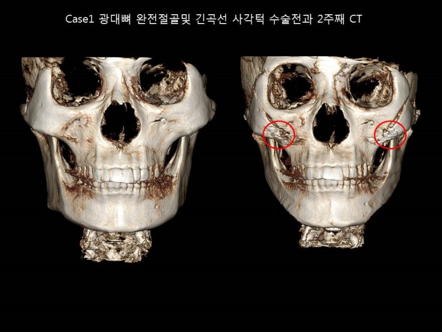 얼굴형에 따른 적절한 광대뼈 축소성형술의 다양한 응용 관련 이미지 3