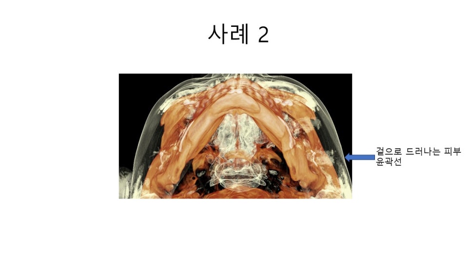 A Zygomatic Surgery Outcome That Makes Anger Surge image 13