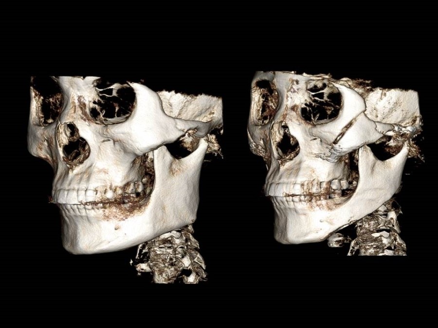 Zygoma Reduction Surgery Through Complete Osteotomy of the Body and Arch image 5