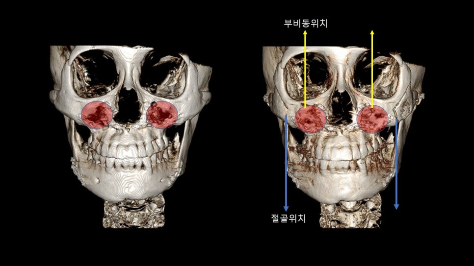 광대뼈축소성형술 증례 리뷰 -1 관련 이미지 9