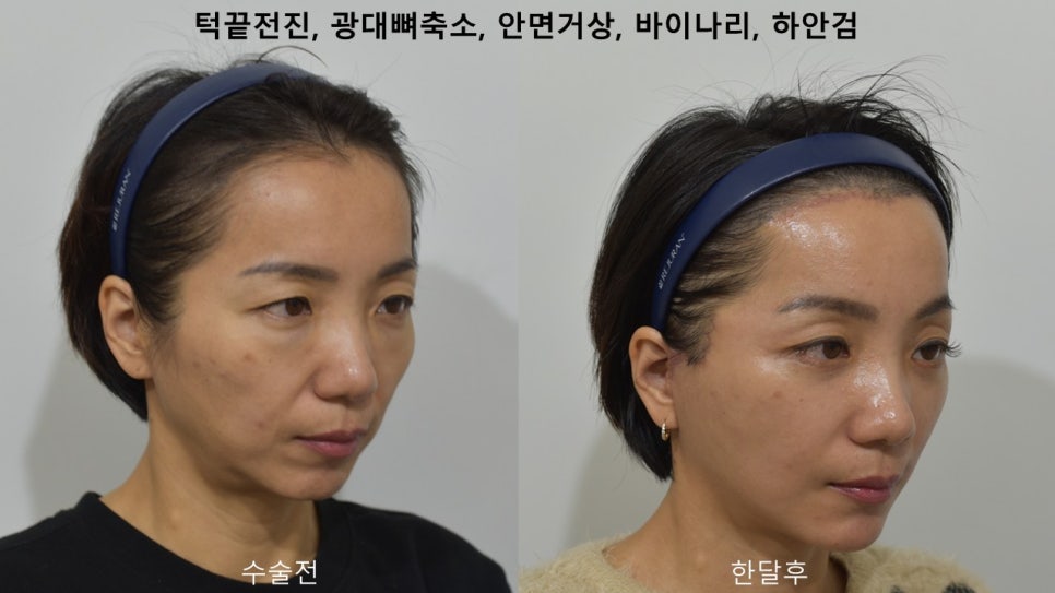 "윤곽거상 수술 " 실제 사례 소개 관련 이미지 12