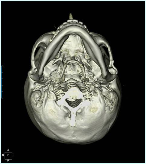 A More Three-Dimensional Cheekbone Shape image 2