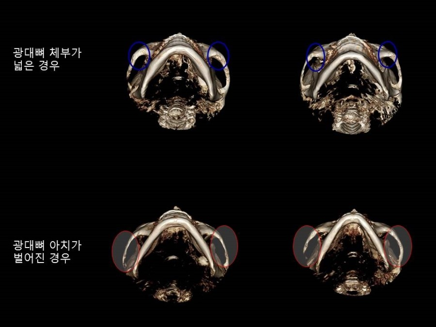 얼굴형에 따른 적절한 광대뼈 축소성형술의 다양한 응용 관련 이미지 2
