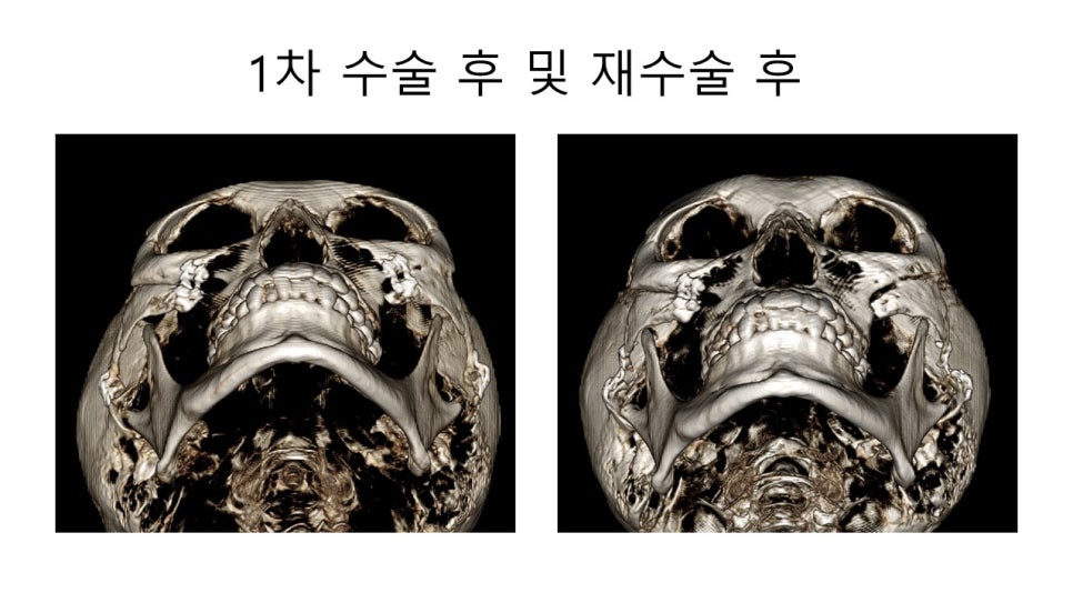 광대뼈 축소성형술 - 수술방법에 따른 모습변화의 차이 관련 이미지 10