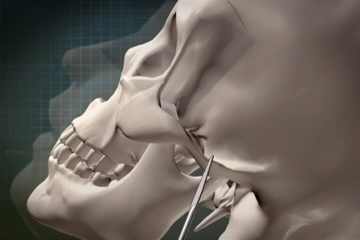 The Evolution of Infracture Technique for Reduction Malarplasty 관련 이미지 1