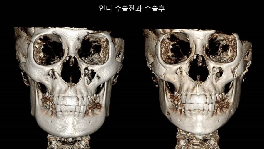 Understanding Square Jaw Surgery - Comparison of Postoperative Results Between Biological Sisters Who Underwent Surgery Using Different Methods image 1