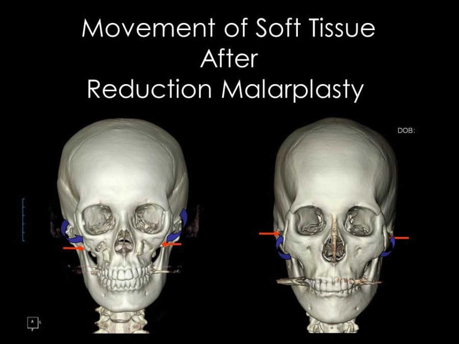 Facial Contouring Surgery and Cheek Sagging image 2