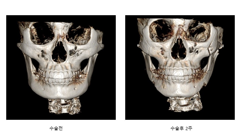 사각턱 수술후 시기에 따른 아랫턱뼈의 형태변화 관련 이미지 20