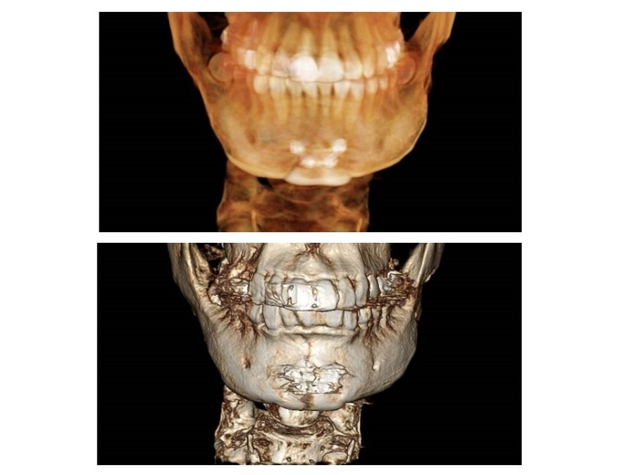 V-Line Square Jaw Surgery - The Appropriate Surgical Method According to the Shape of the Chin image 9