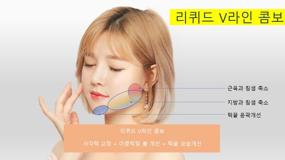 Step-by-Step Suggestions on Facial Contouring Surgery - 1. Liquid Facial Contouring image 8
