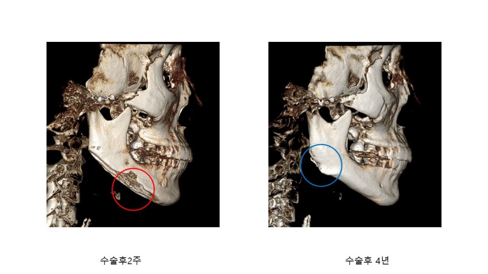 사각턱 수술후 시기에 따른 아랫턱뼈의 형태변화 관련 이미지 29