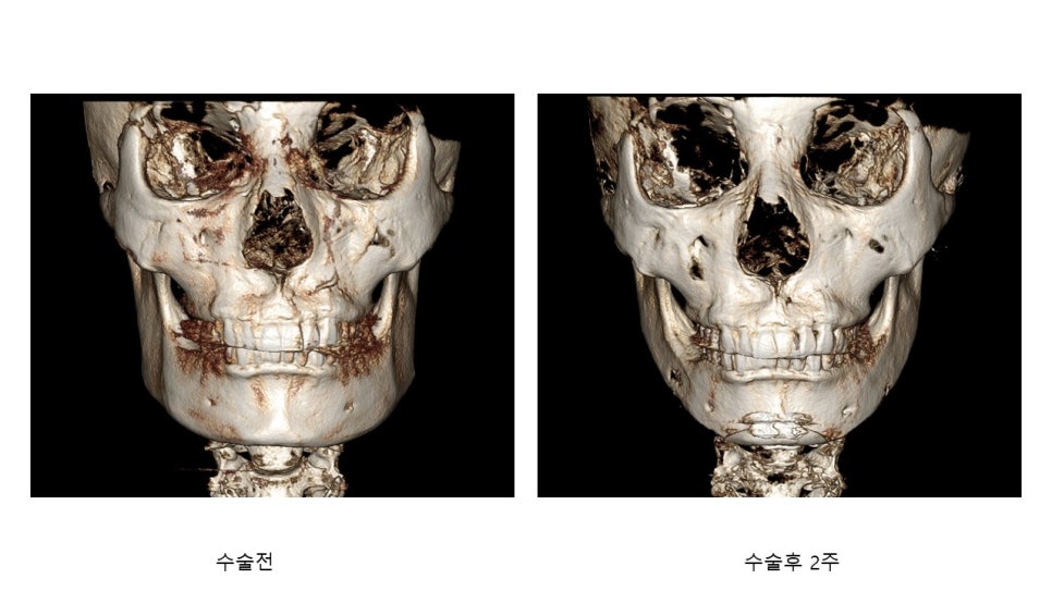 사각턱 수술후 시기에 따른 아랫턱뼈의 형태변화 관련 이미지 5