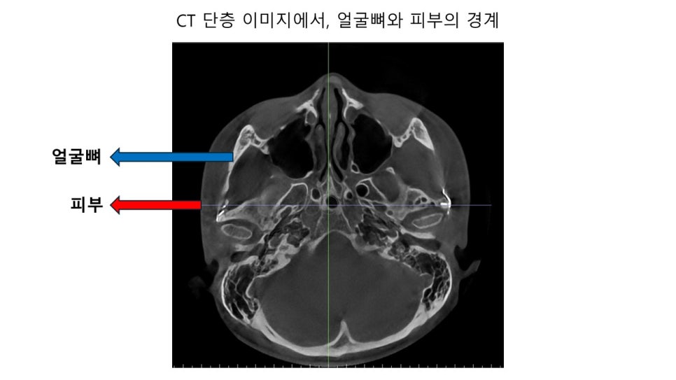 얼굴 윤곽에 있어서 연부조직의 중요성 - 윤곽주사, 레인보우 주사 관련 이미지 3