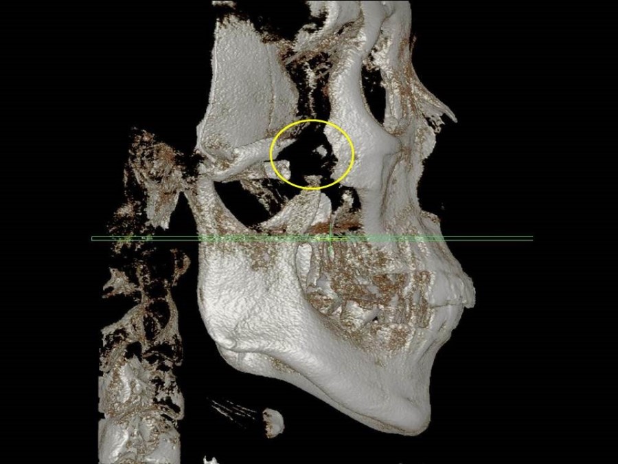 Complication Cases of Zygomatic Reduction Surgery image 3