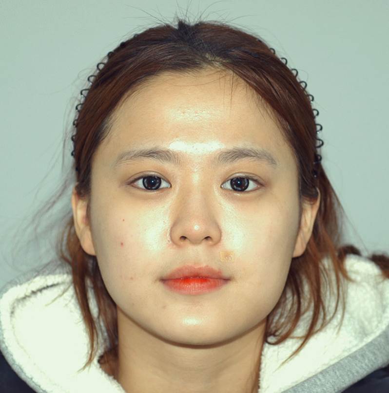 Progress After Facial Contouring Surgery 1 - Zygoma Reduction Surgery and Square Jaw Surgery image 1