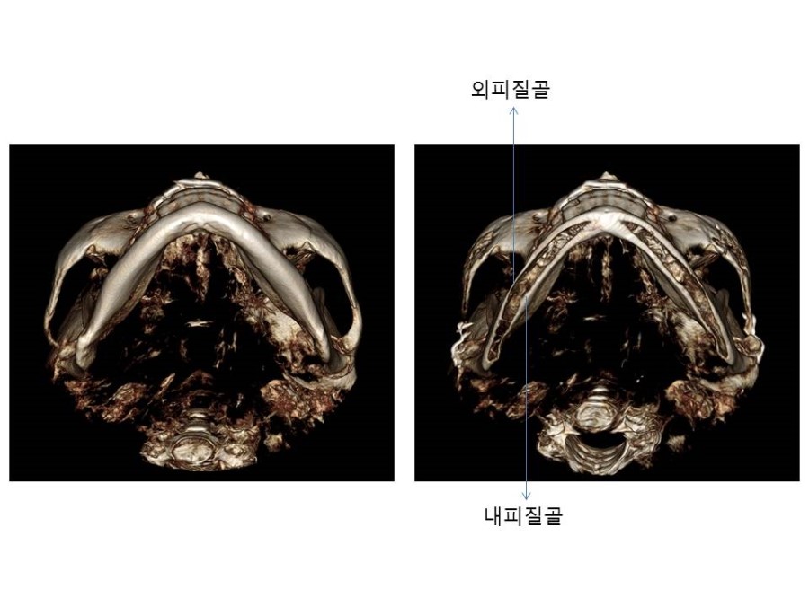 Proper Understanding of Cortical Bone Resection or Cortical Bone Reduction in Square Jaw Surgery image 6
