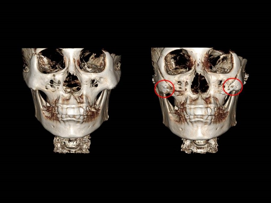 Zygoma Reduction Surgery Through Complete Osteotomy of the Body and Arch image 13