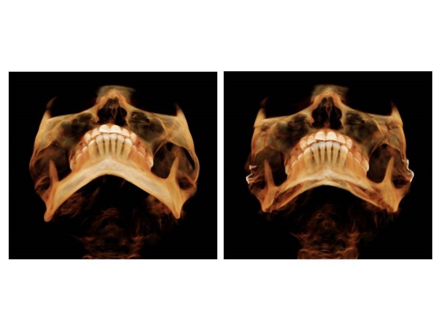 Proper Understanding of Cortical Bone Resection or Cortical Bone Reduction in Square Jaw Surgery image 12