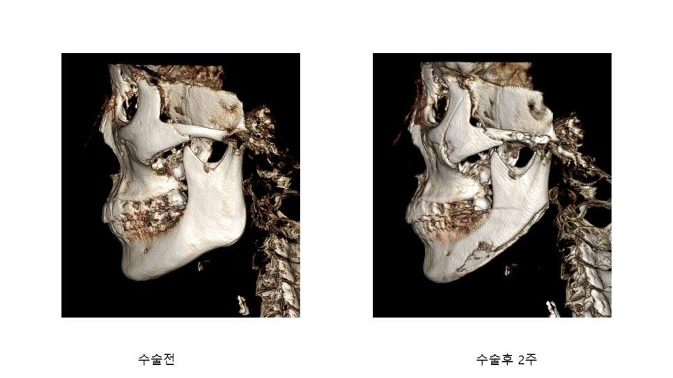 사각턱 수술후 시기에 따른 아랫턱뼈의 형태변화 관련 이미지 26