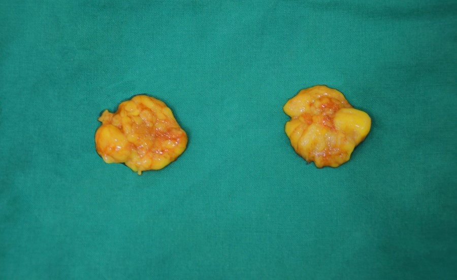 The Amount of Deep Buccal Fat Removed During Deep Buccal Fat Removal image 5