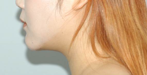 Double Chin Liposuction image 3