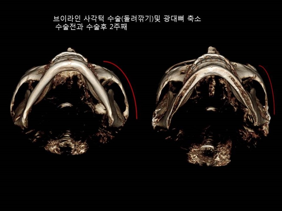 얼굴형에 따른 광대뼈 축소성형술 방법의 적절한 선택 관련 이미지 6