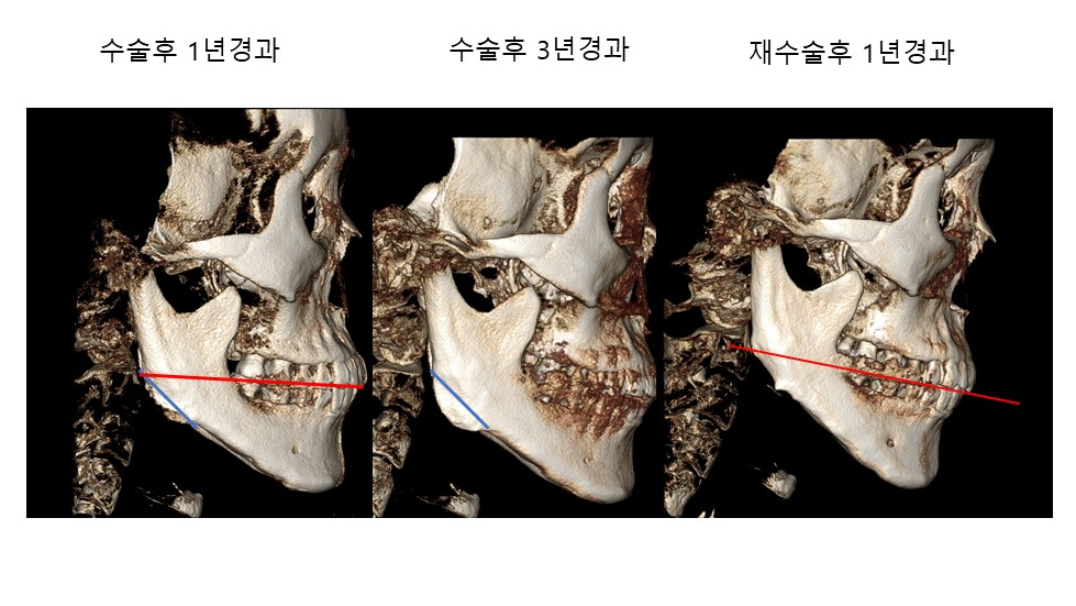 Bone Regeneration after Square Jaw Surgery 관련 이미지 3