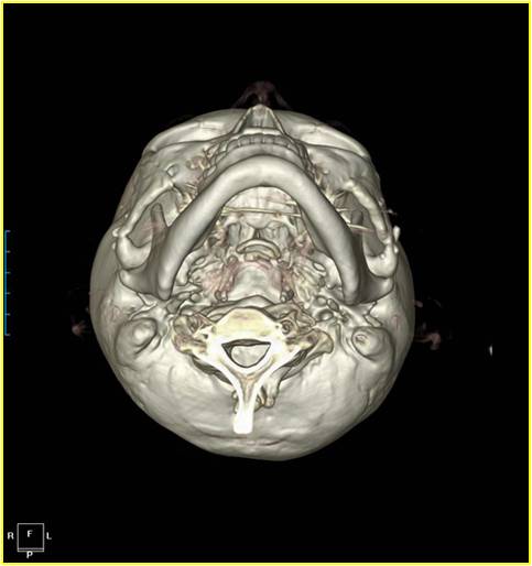 A More Three-Dimensional Cheekbone Shape image 1