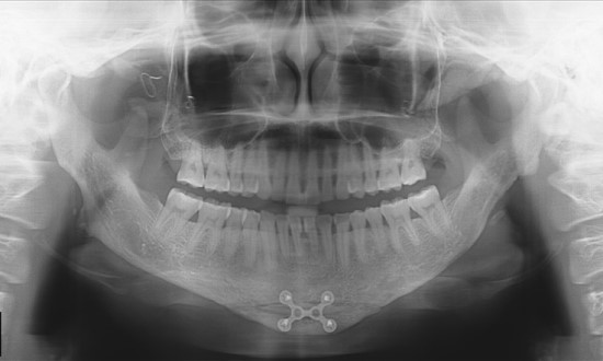 V-Line Square Jaw Revision Surgery image 8