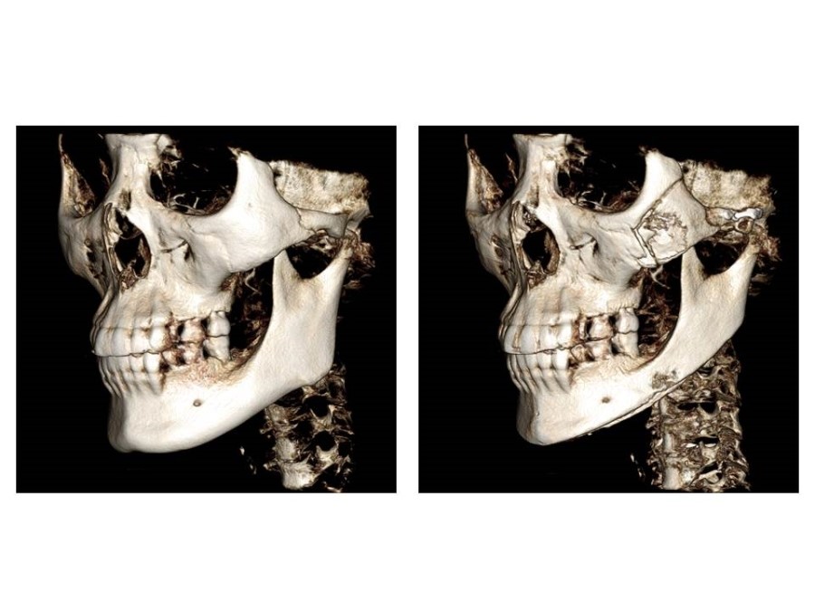 Proper Understanding of Cortical Bone Resection or Cortical Bone Reduction in Square Jaw Surgery image 9