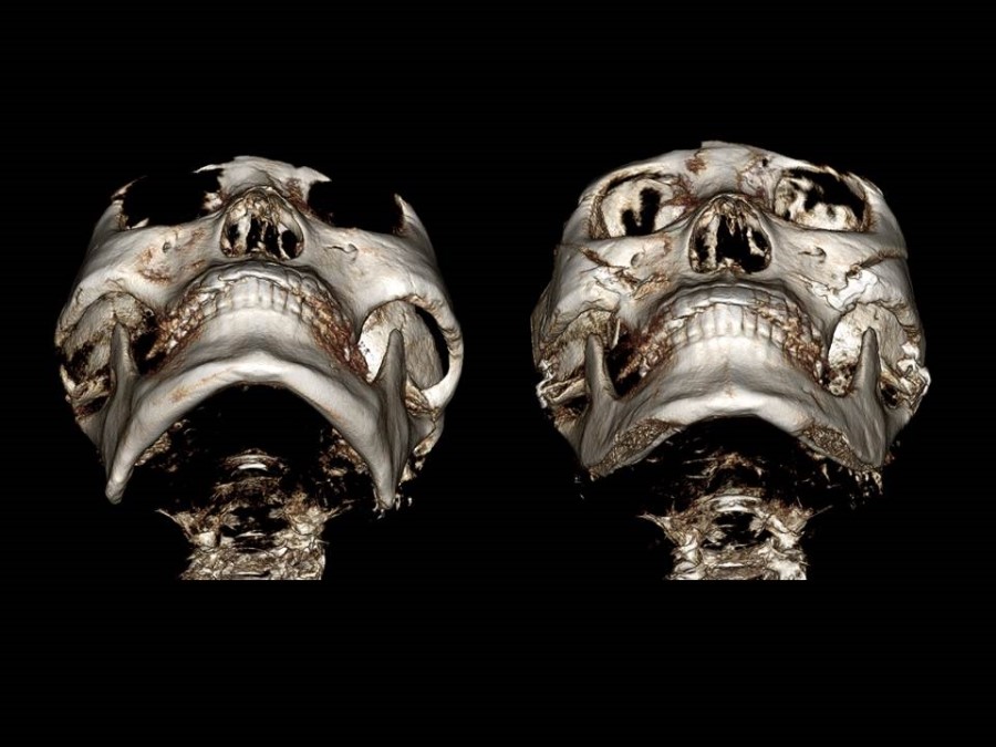 Zygoma Reduction Surgery Through Complete Osteotomy of the Body and Arch image 10