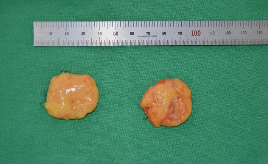 The Amount of Deep Buccal Fat Removed During Deep Buccal Fat Removal image 2