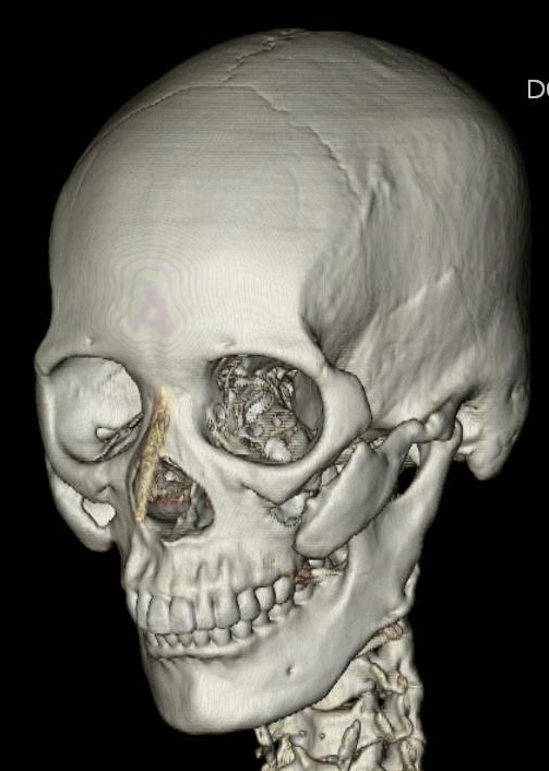 광대뼈 축소성형술시 비고정 수술법? 3D-CT로 확인 합시다. 관련 이미지 2