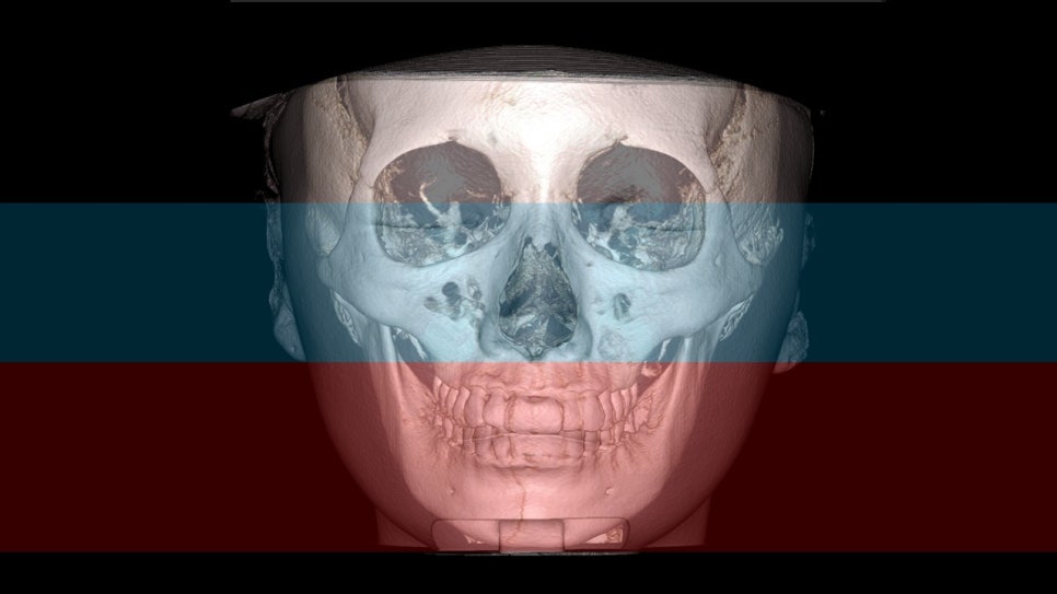 How Is Face Shape Determined? Factors That Determine Face Shape and Facial Contouring Surgery image 15