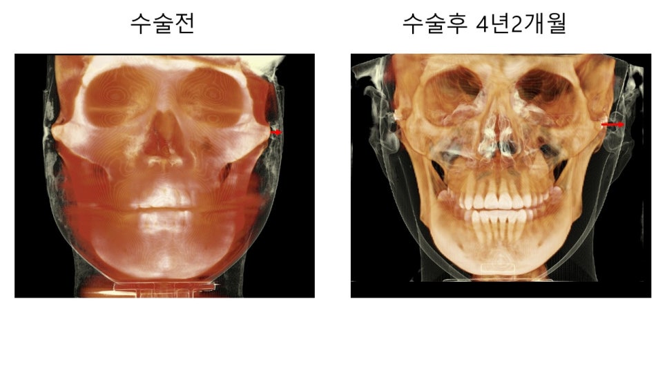 얼굴 윤곽에 있어서 연부조직의 중요성 - 윤곽주사, 레인보우 주사 관련 이미지 7