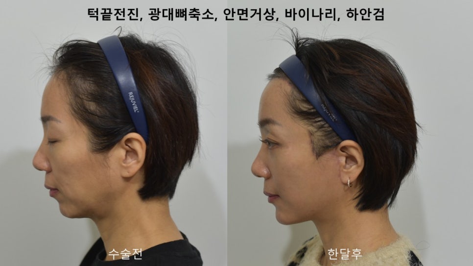 "윤곽거상 수술 " 실제 사례 소개 관련 이미지 11